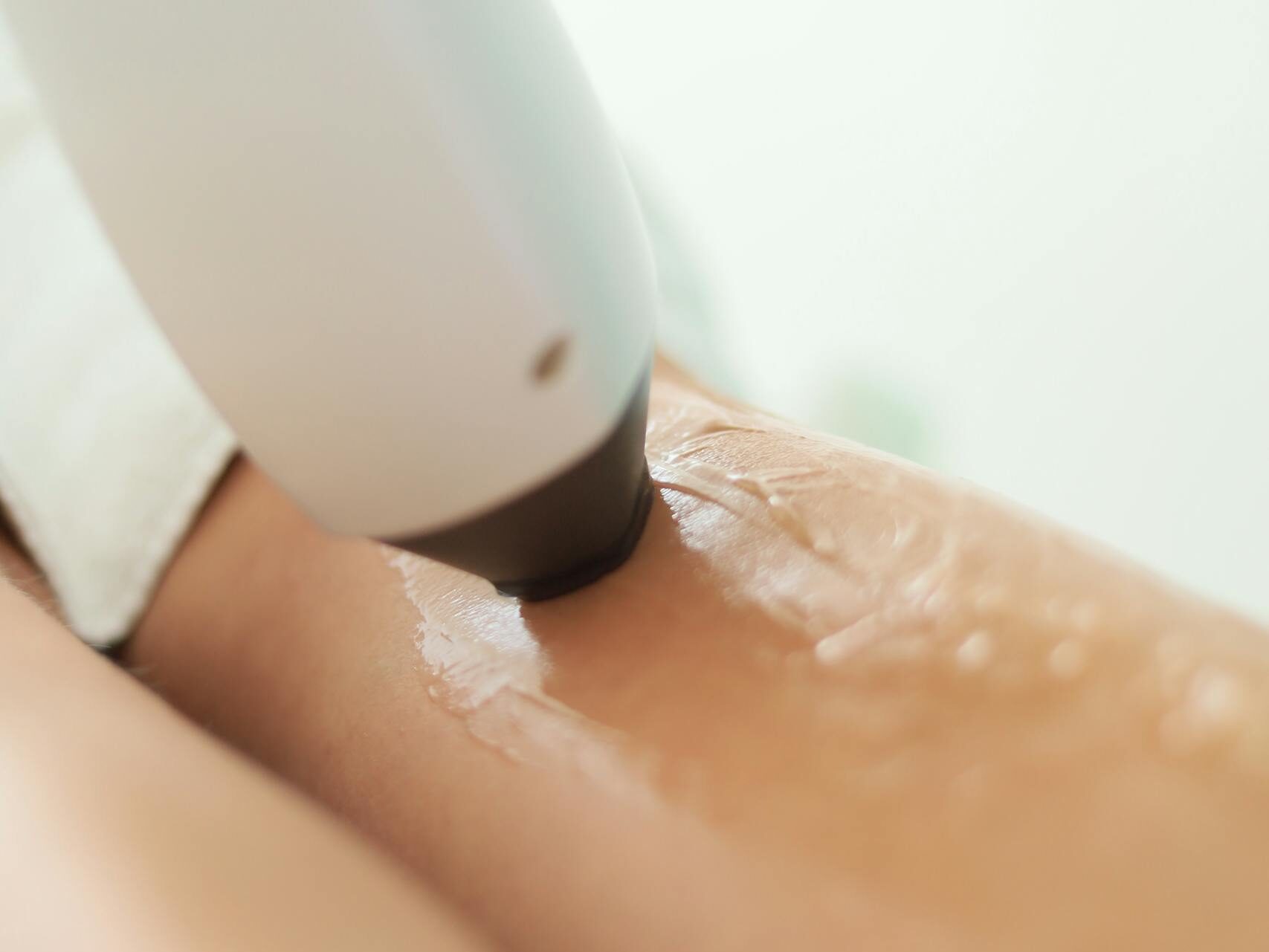 Close-up of a laser hair removal procedure on smooth skin, emphasizing beauty and skincare.